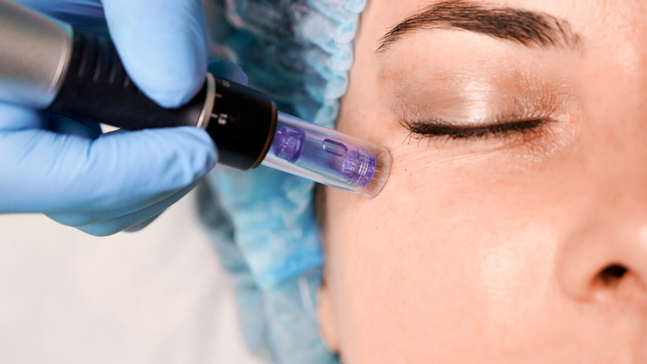 Microneedling Benefits