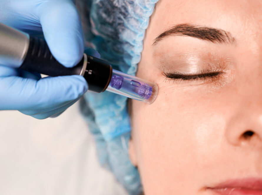 Microneedling Benefits