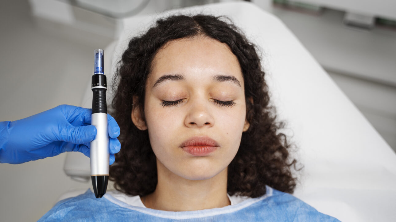 Microneedling